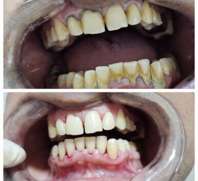 Best treatment for periodontitis