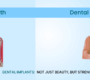 Dental Implants blog new 1 90x80